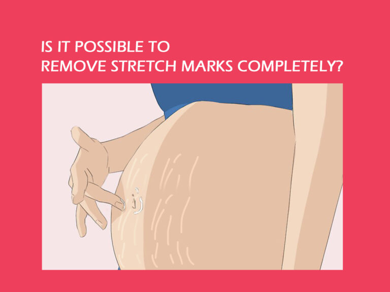 Read more about the article Getting Rid of Pregnancy Stretch Marks